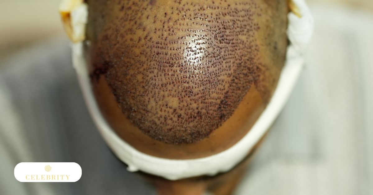 A high-angle, close-up view of a patient's scalp shows the precise placement of newly implanted follicles, illustrating the clinical results immediately following a hair transplantation procedure.