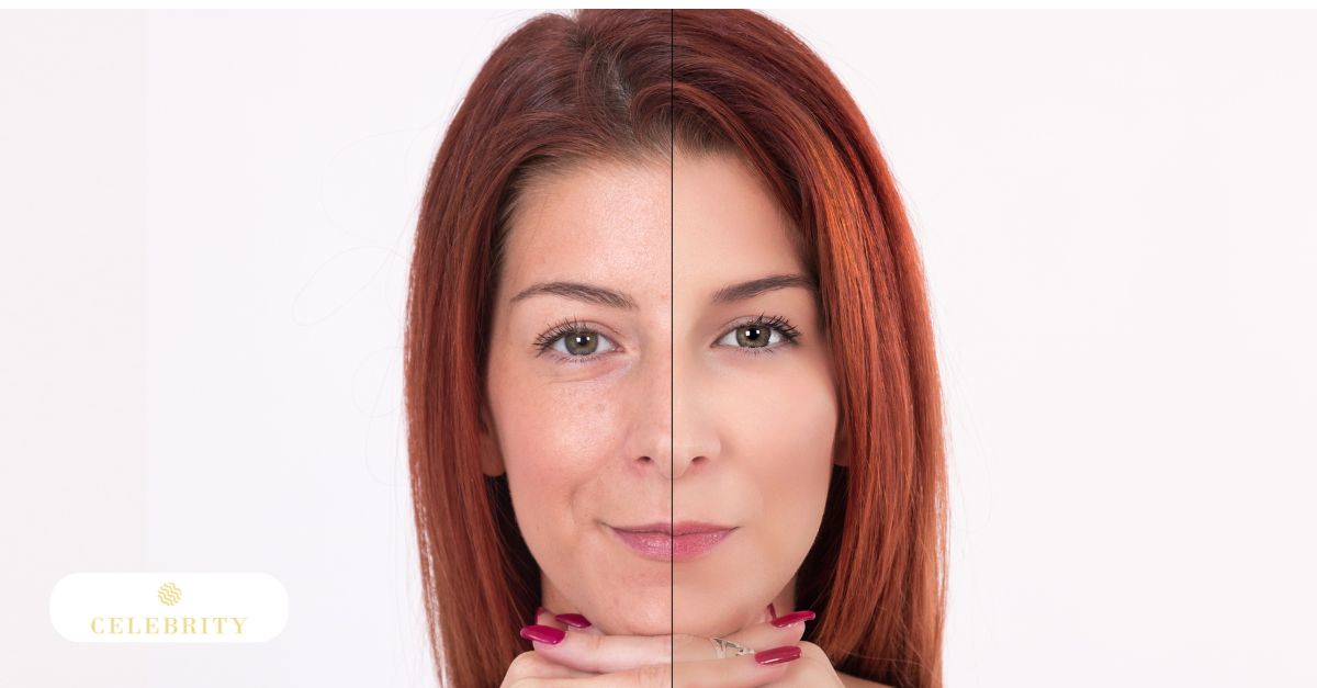Side-by-side comparison of a woman’s face before and after the BOTOX