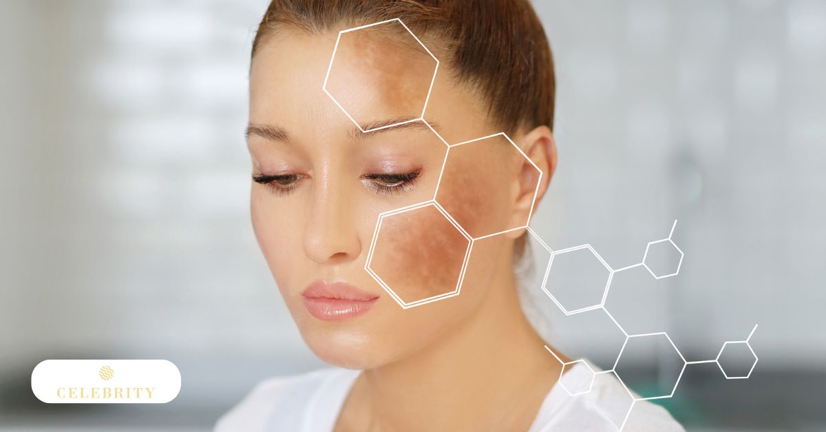 A woman with hyperpigmentation on her face.