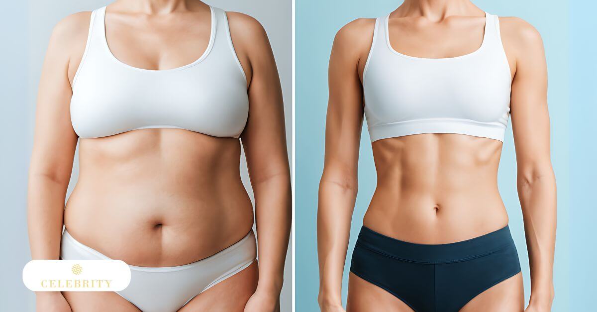 Before and after photos showcasing a woman's tummy, highlighting VelaShape II treatment results