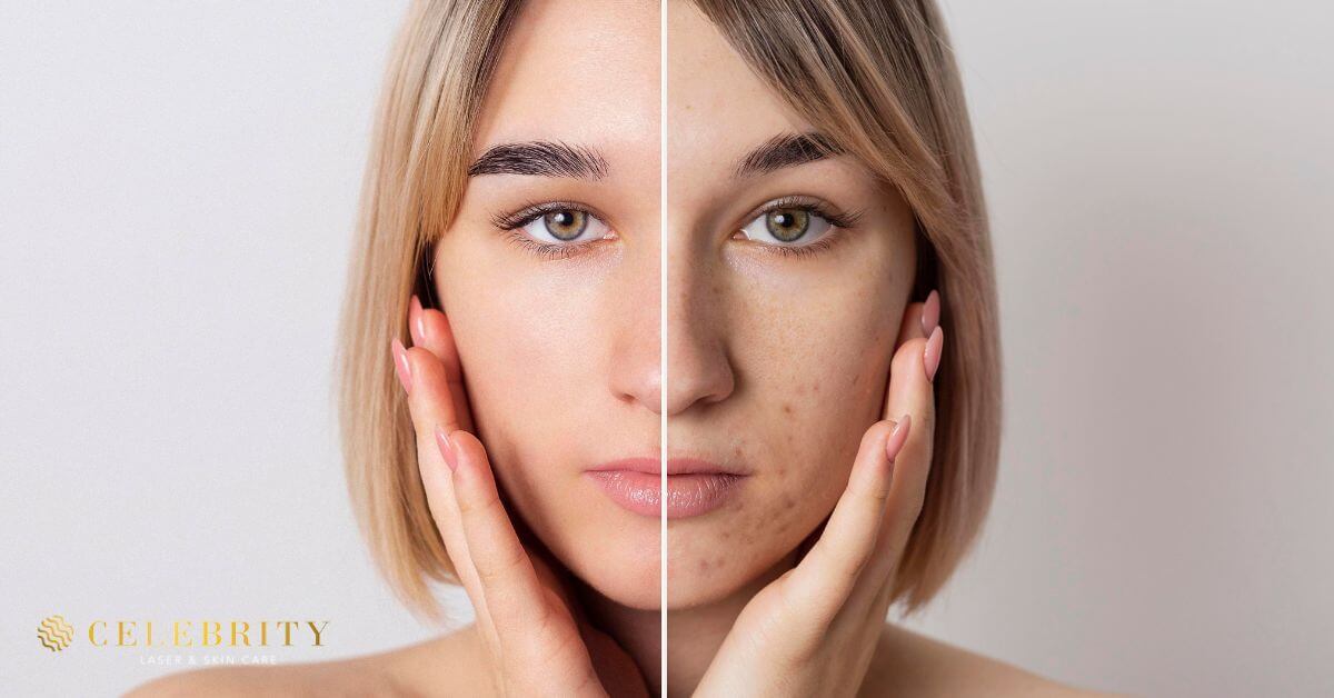 Woman's face showing acne before and after HydraFacial treatment for oily and acne-prone skin