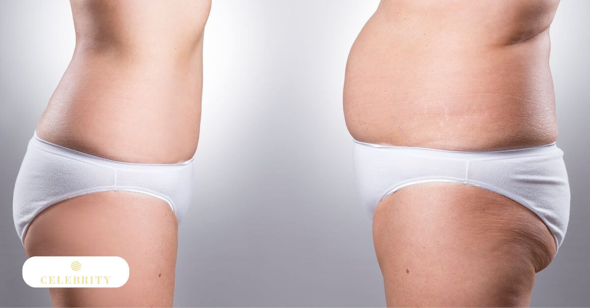 Before and after images showing a woman's tummy, highlighting BodyFX skin tightening and fat reduction results