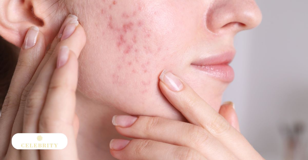 Close-up of a woman's cheek with acne scars treated at Celebrity Laser & Skin Care
