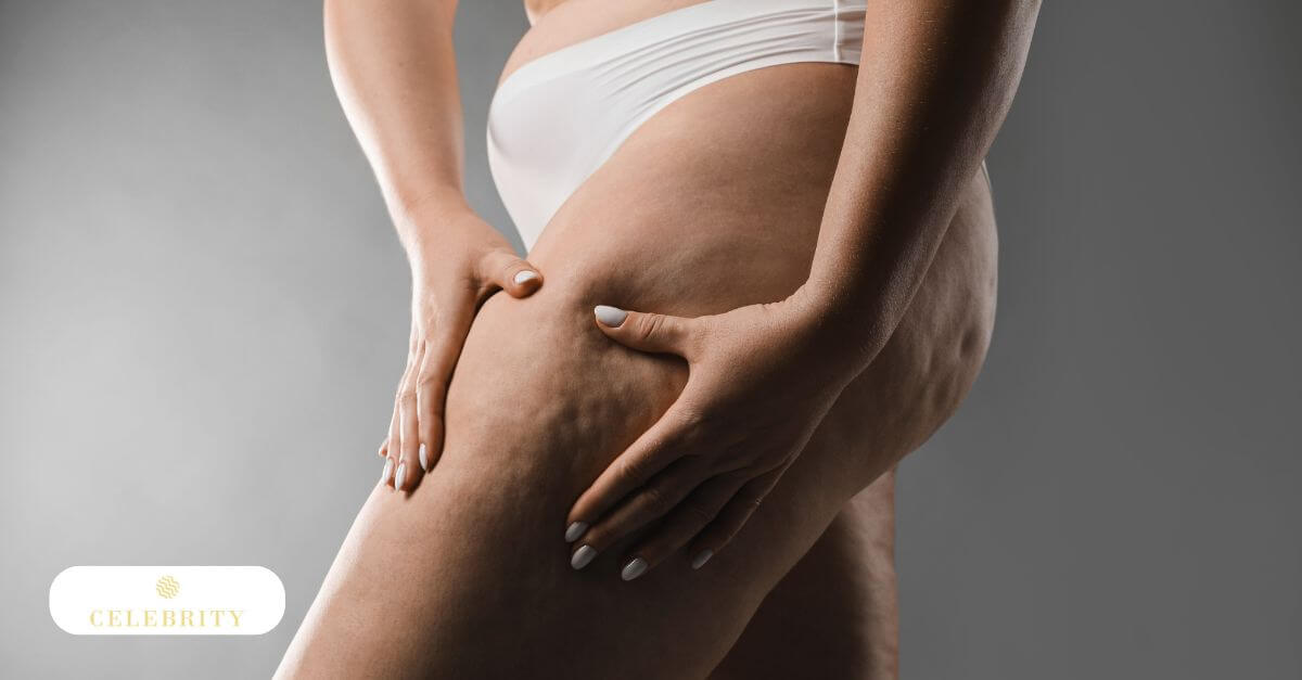 Before and after images showing a woman's butt, highlighting results of cellulite reduction treatments
