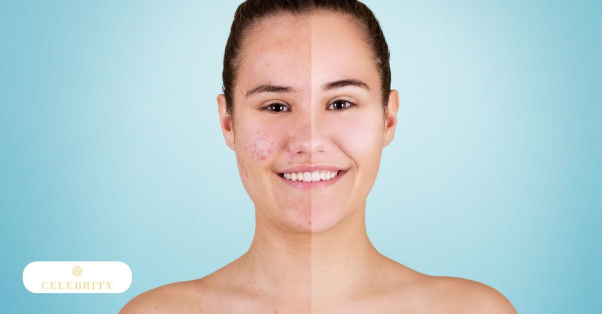 Before and after images of a woman's nose, illustrating the effectiveness of microdermabrasion in minimizing blackheads