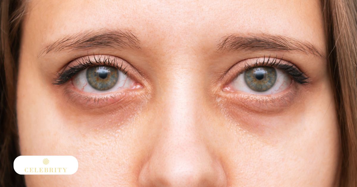 A woman with distinct under-eye bags