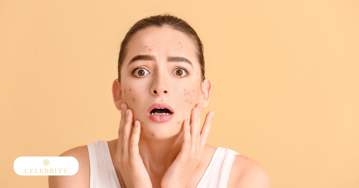 A woman with acne on her face, highlighting the need for effective acne treatment solutions