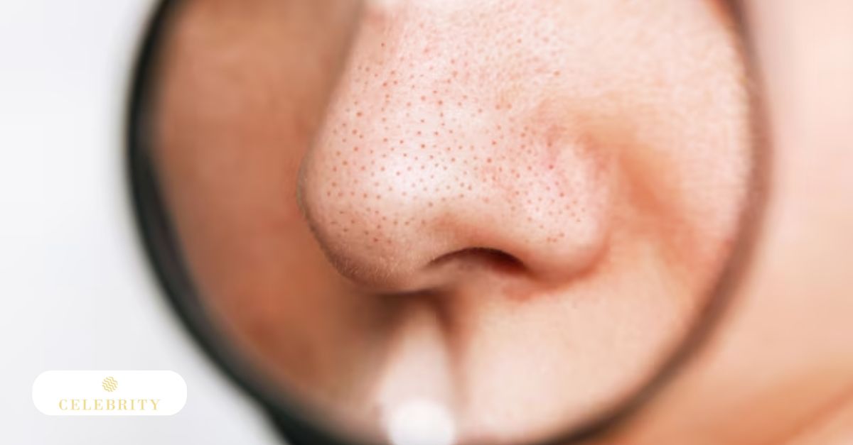 A woman pointing to a blackhead on her nose, highlighting common facial skin pore congestion.
