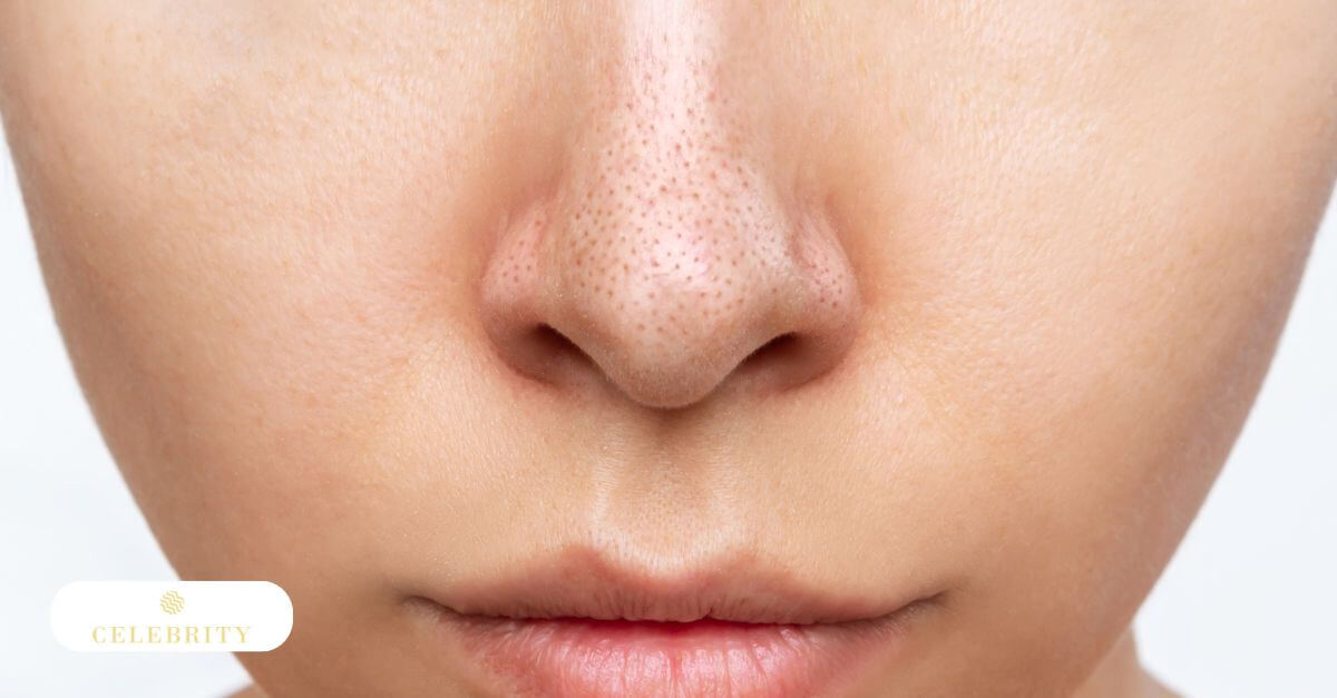 Skin with blackheads