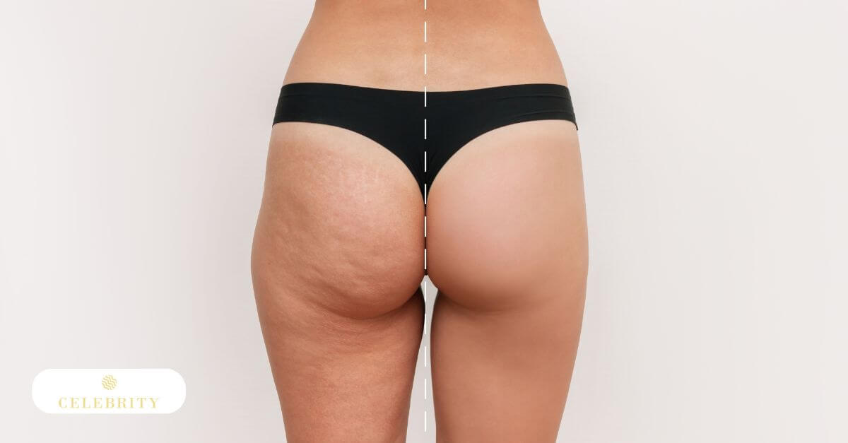 Before and after images of a woman's butt showcasing results from VelaShape II non-invasive body contouring treatment