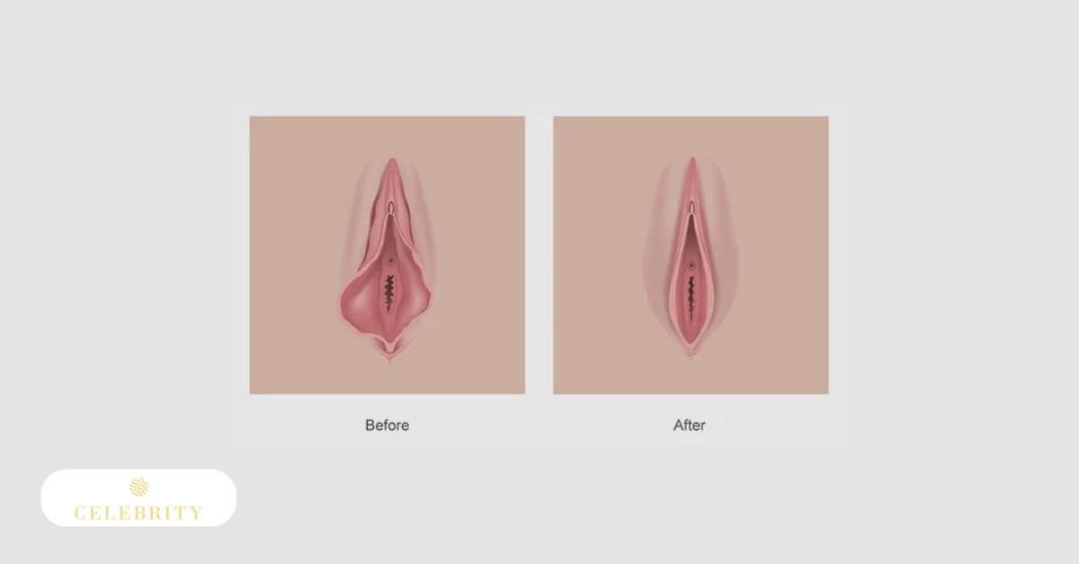 Comparative images illustrating the effects of non-invasive Votiva vaginal tightening treatment on vaginal laxity