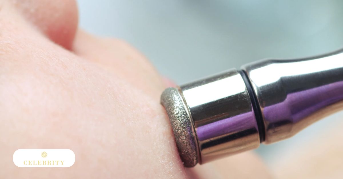 A technician using a specialized microdermabrasion wand to gently exfoliate and clear a client's chin.