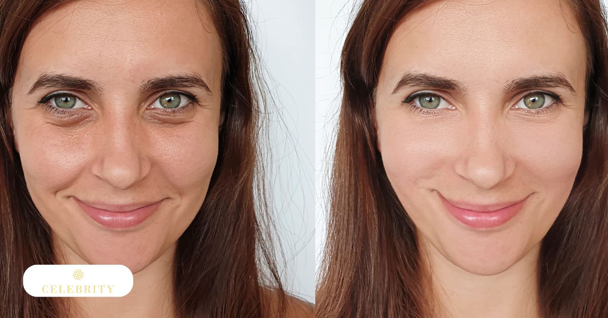ide-by-side images of a woman showing her face before and after non-surgical skin tightening treatments