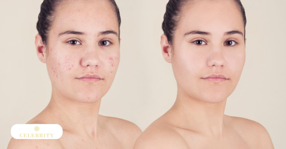 How often should you do microneedling for acne scars
