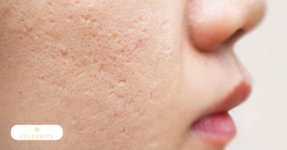 A woman receiving a microneedling treatment on her face