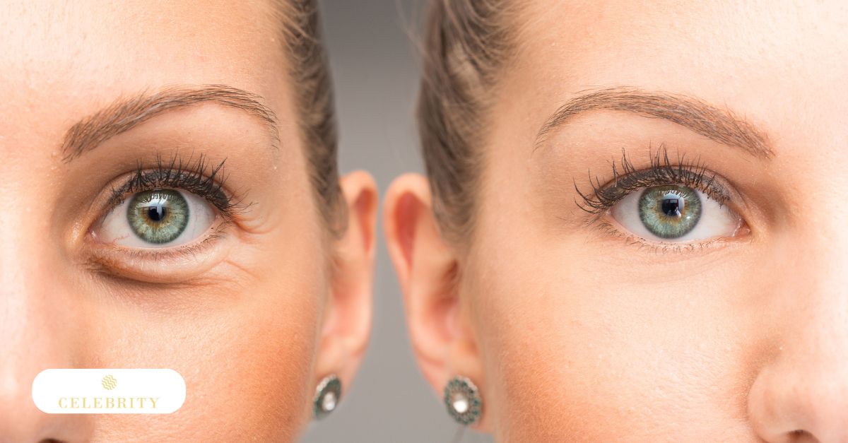 Comparison photos of a woman's eyes, highlighting results of Morpheus8 radiofrequency microneedling for under-eye bags