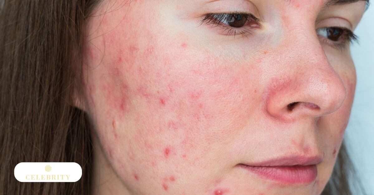 What rosacea is and how it affects women’s skin and confidence