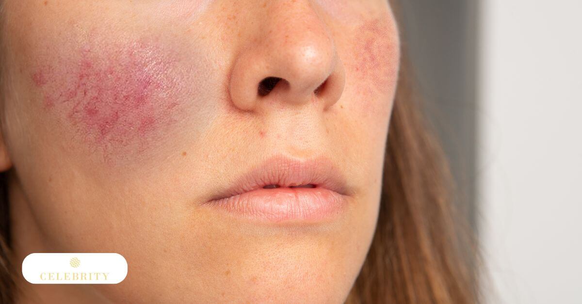 Targeting visible veins with laser for smoother, clearer skin