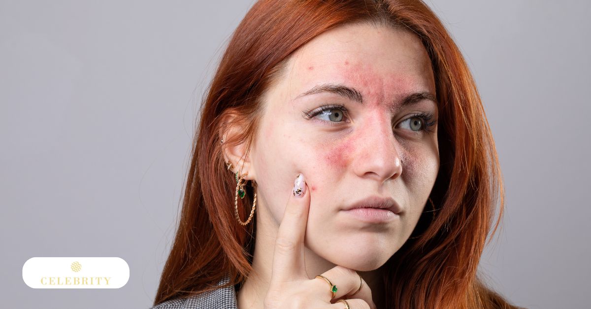 Common rosacea triggers and risk factors, including genetics