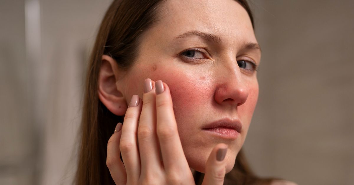 A woman experiencing slight redness after a microneedling session