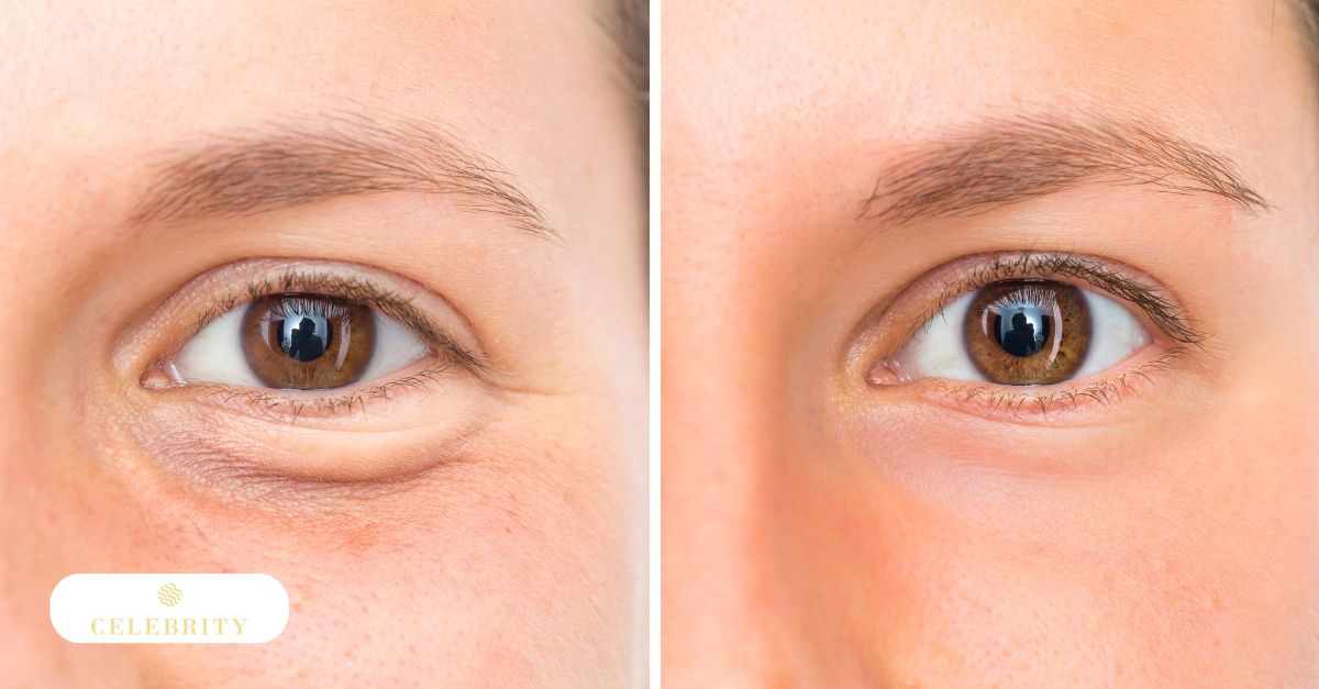 A woman smiles at her reflection in the mirror, showcasing her improved appearance after Morpheus8 treatment for under-eye bags