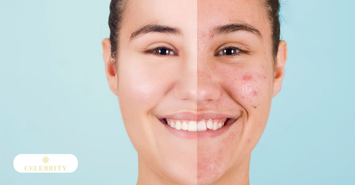 Woman's face showing acne before and after AviClear non-invasive laser treatment for acne