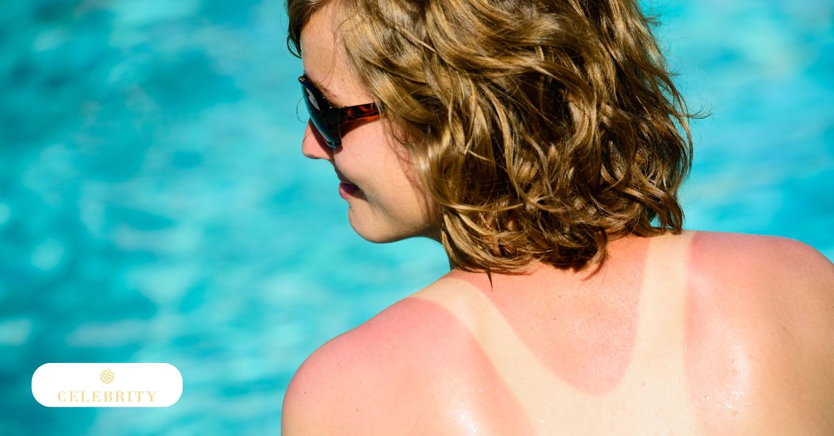 Person with sunburned shoulders by pool, showing redness and peeling from prolonged sun exposure.