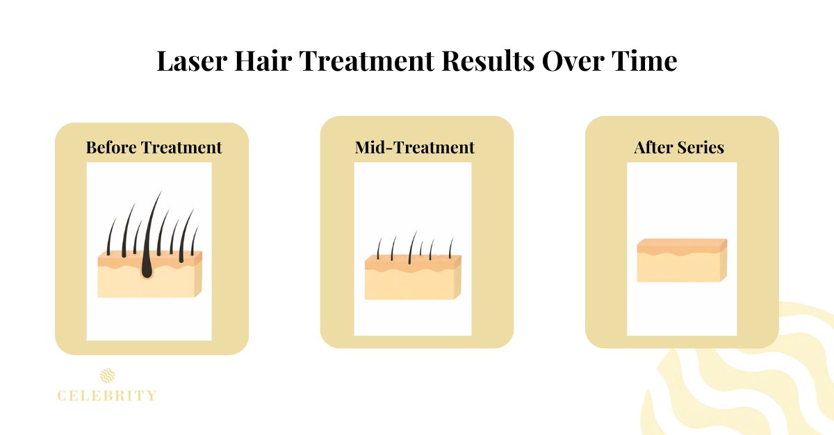 nfographic showing laser hair treatment results over time, comparing before treatment, mid-treatment, and after a full series.