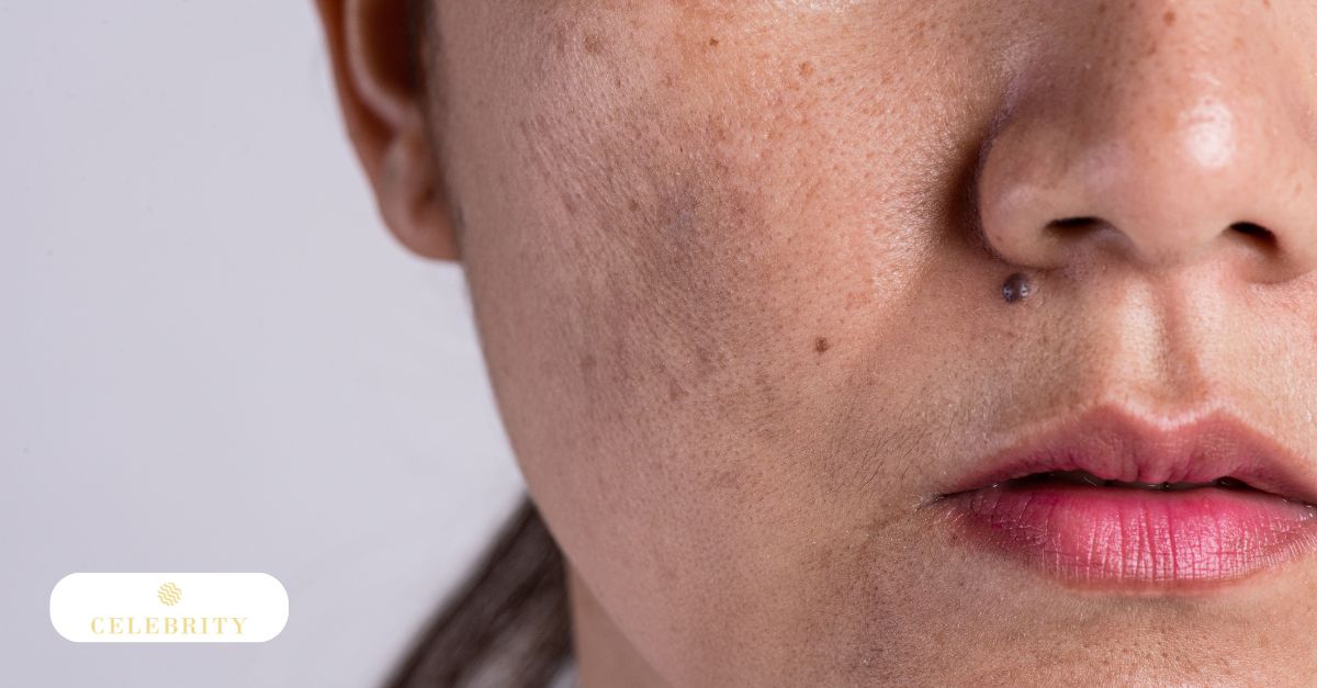 Uneven skin tone treated with light-based pigmentation therapy
