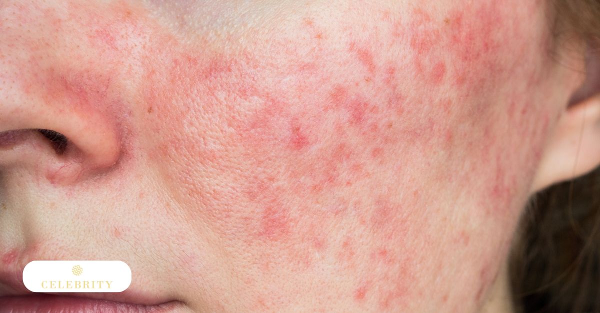 Rosacea-related facial redness before ADVATx or IPL treatment