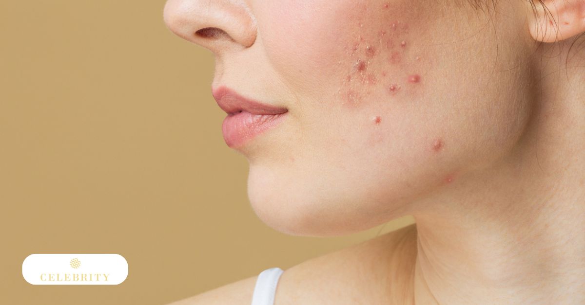 Close-up profile of a woman's face showing red inflamed acne breakouts and blemishes on her cheek and jawline.