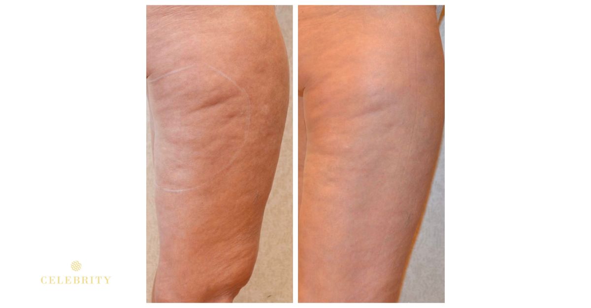 Before and after VelaShape II treatment showing visible improvement in skin smoothness and reduced cellulite appearance