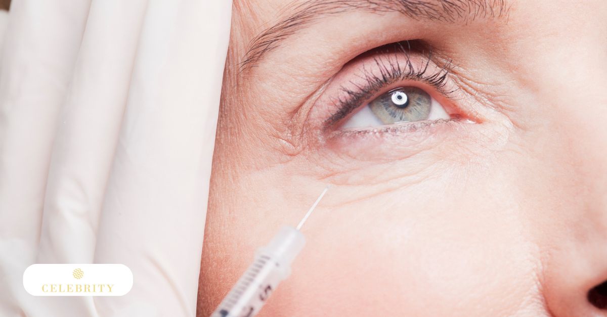  Close-up of PRP treatment beneath the eyes related to how often PRP under-eye sessions may be needed