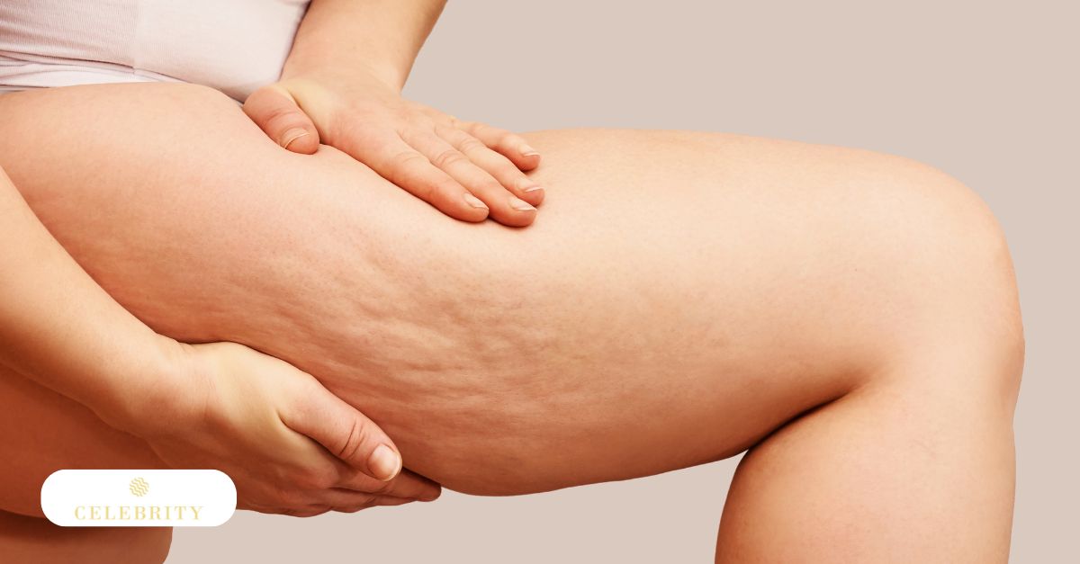  Visible thigh cellulite formed by fat deposits beneath the skin and fibrous bands