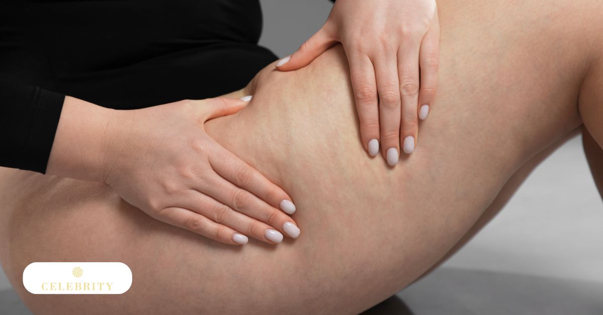 Visible cellulite on the thigh, presenting as uneven, dimpled skin texture