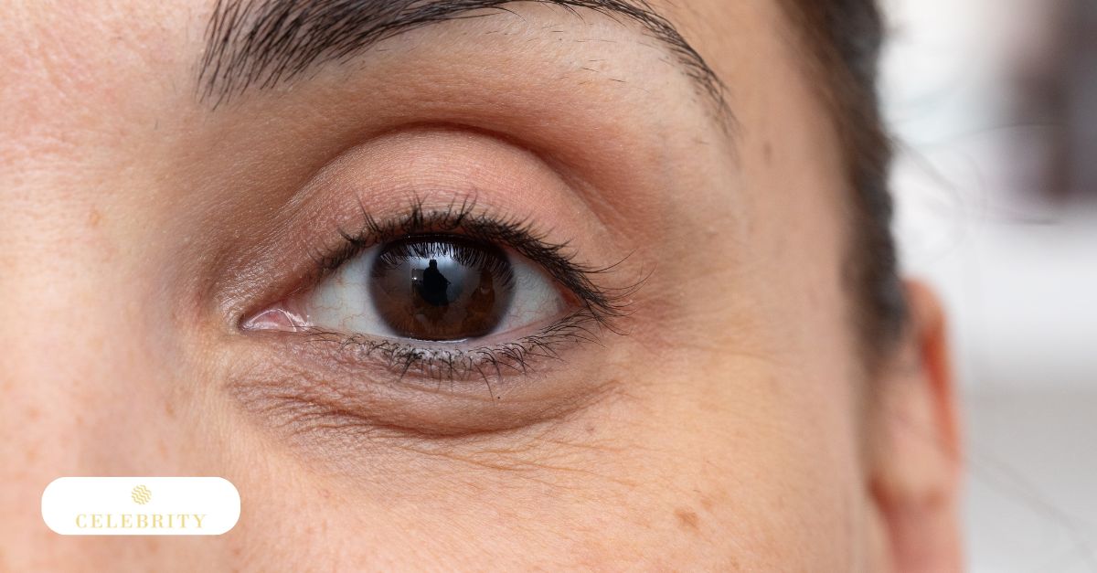 Close-up of aging under-eye skin with fine lines and tired appearance around the eyes
