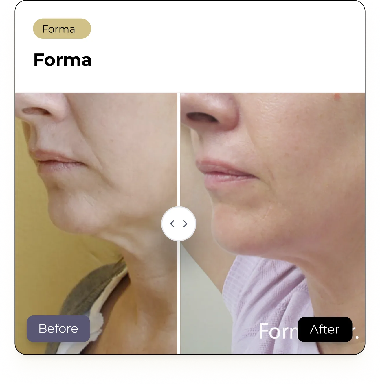 BeforeAfterCard