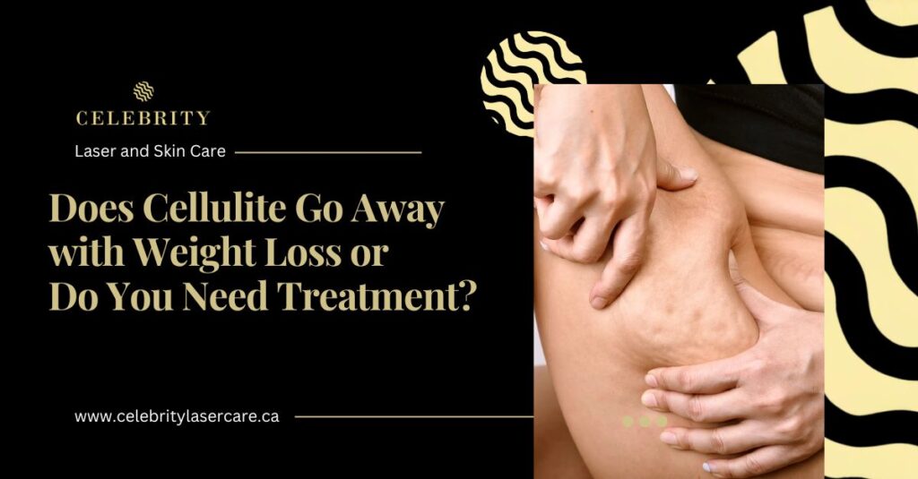 Does Cellulite Go Away With Weight Loss or Do You Need Treatment?