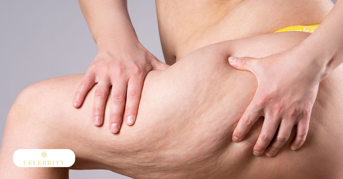 Close-up of cellulite on a person's leg, exploring the discussion of why collagen alone isn&rsquo;t enough to improve cellulite.