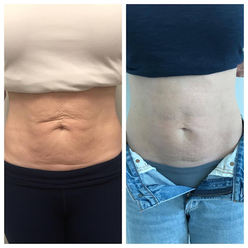 Post-Pregnancy Abdominal Contouring With EMSCULPT NEO + Morpheus8