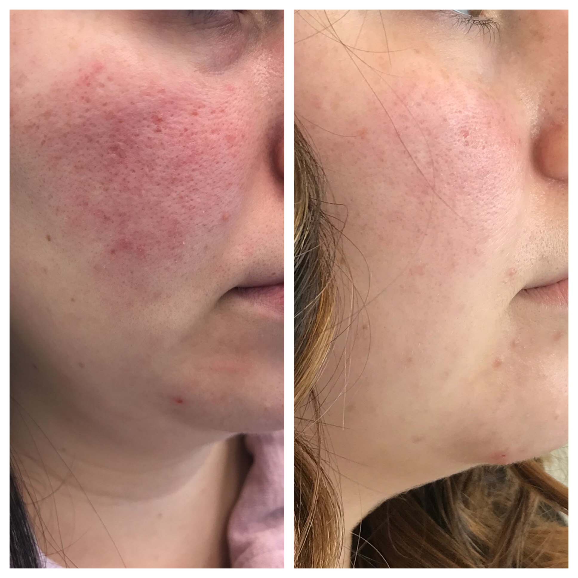 Laser treatment for rosacea before and after