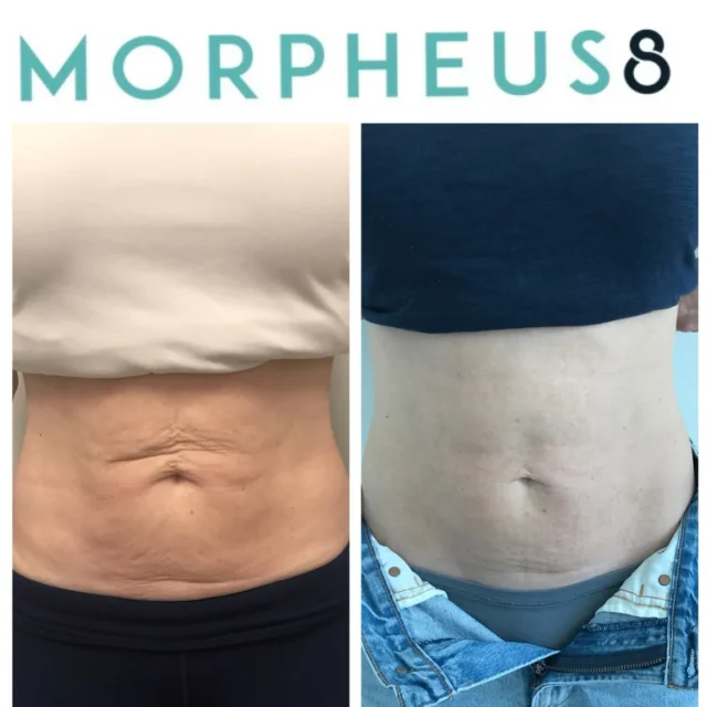 Morpheus8 (RF-Microneedling) by @inmodeaesthetics @bc_inmodeInterested in free / no obligation consultation? Pls Contact us now👇💻 website: https://celebritylasercare.ca
📞 call: 604-912-0220
💌Email: info@celebritylasercare.com
📍 Location: North Vancouver.
.
.
#northvancouver #medispa #mycelebrity #skingoal #vancouvermedispa #vancouveraesthetics #celebritylaser ⁠⁠ #medicalaesthetics #vancouveraesthetics ⁠⁠#timetoglow #skincare #skintreatment#morpheus8 #skintightening #looseskinproblems